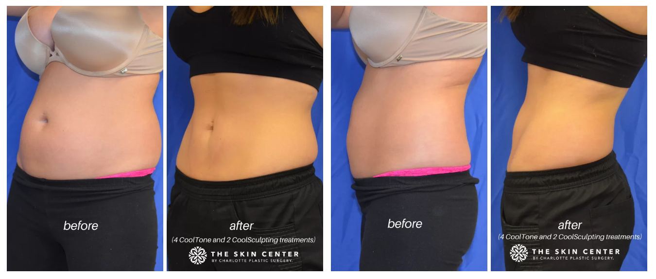 charlotte Cooltone by coolsculpting patient Before After