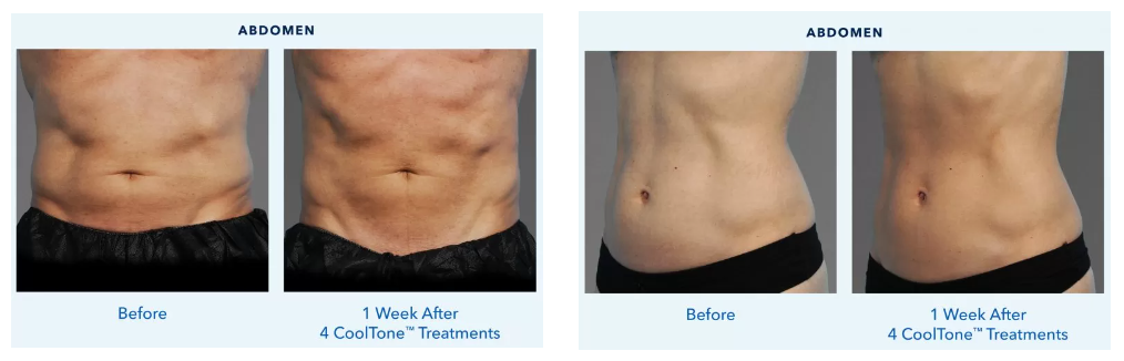 charlotte cooltone by coolsculpting patients before and after