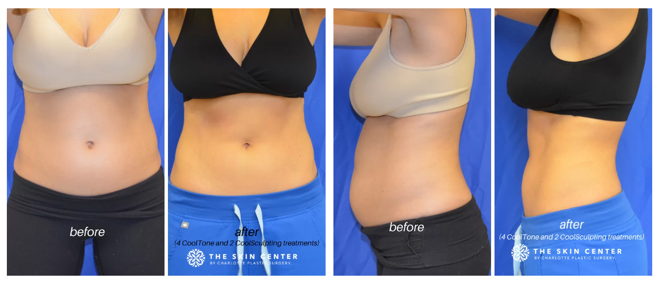 charlotte Cooltone patients Before After