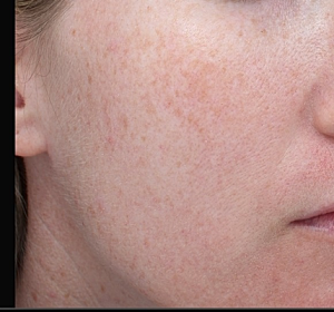age spots hyperpigmentation