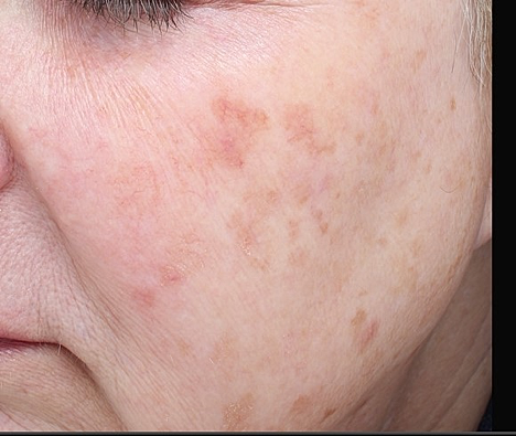 age spots type of hyperpigmentation