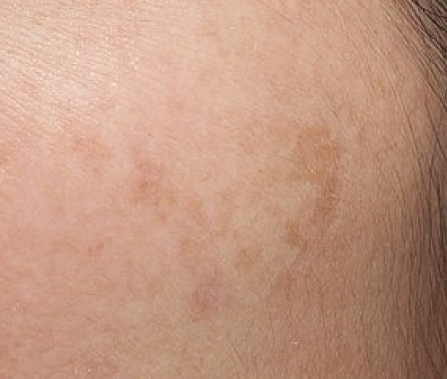 different types of hyperpigmentation