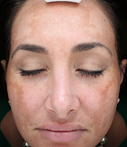 melasma hyperpigmentation