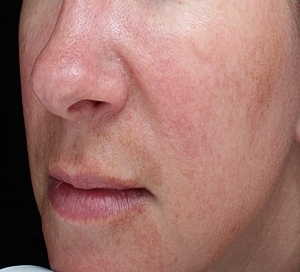 melasma type of hyperpigmentation
