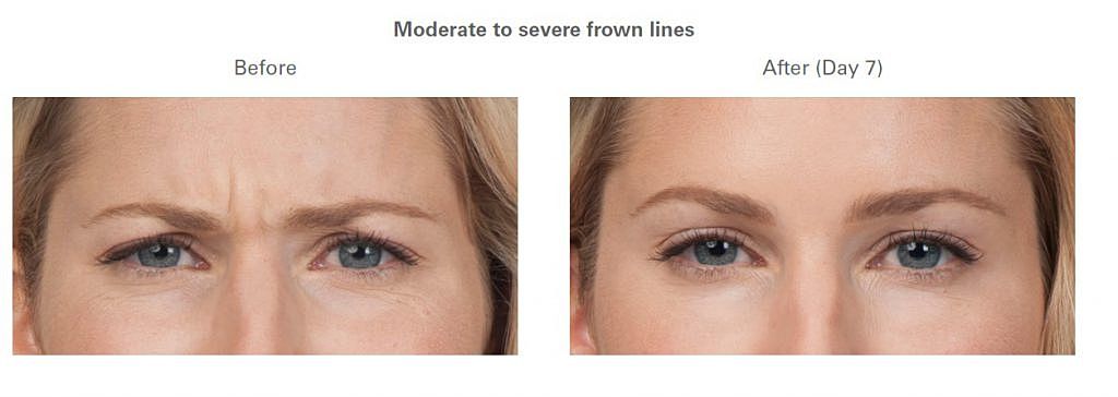 things to know before getting botox