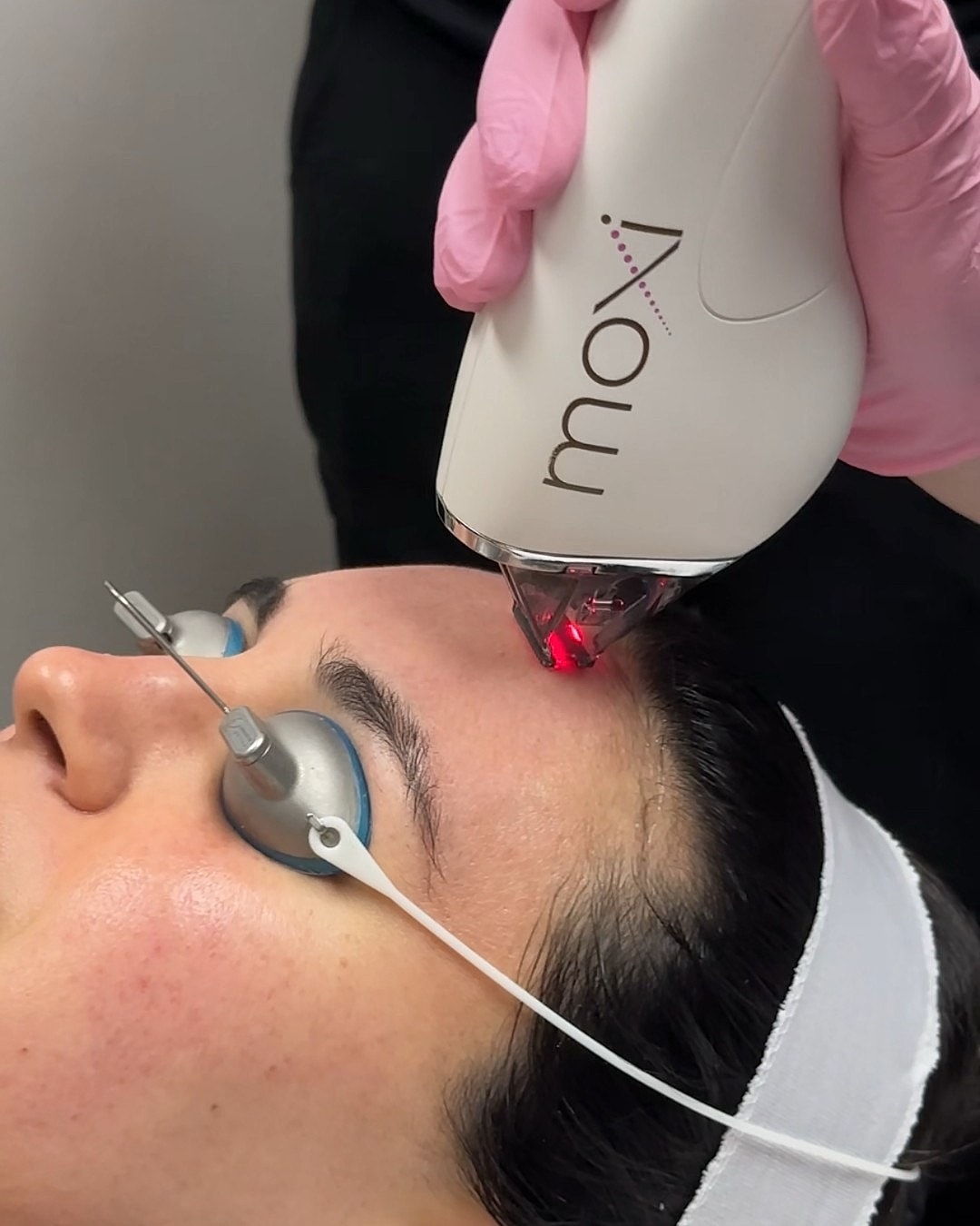 Laser treatment in progress on a client's forehead.