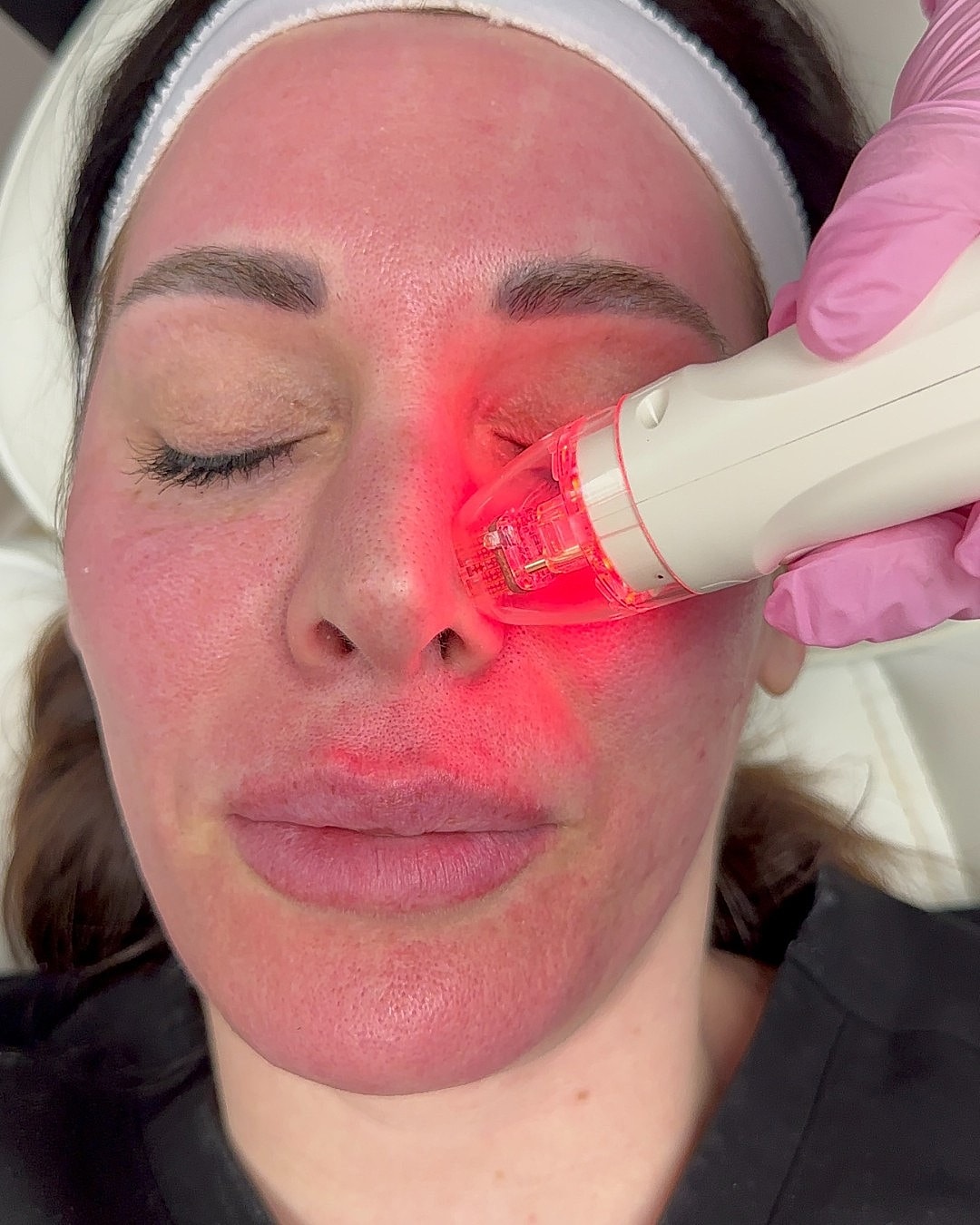 Facial treatment with red light therapy device.
