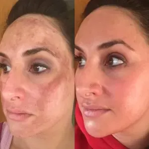 advanced corrective peel results