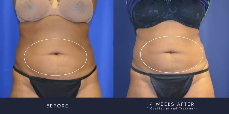 CoolSculpting Patient Results