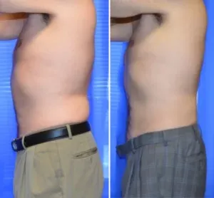 Side View before and after example on male