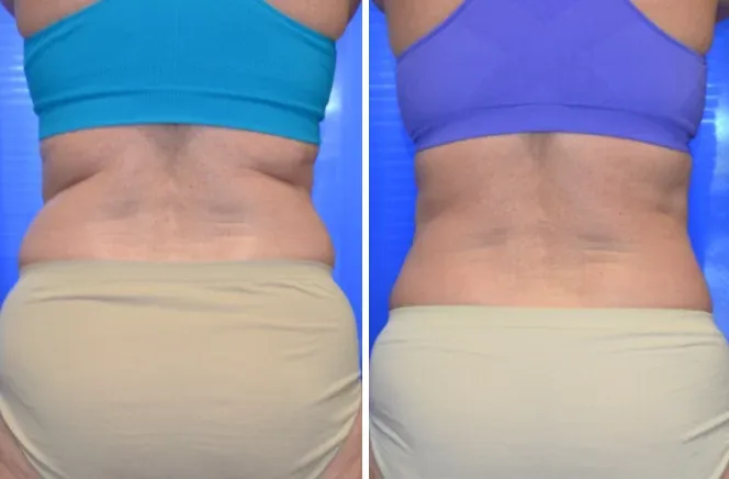 CoolSculpting Before and After
