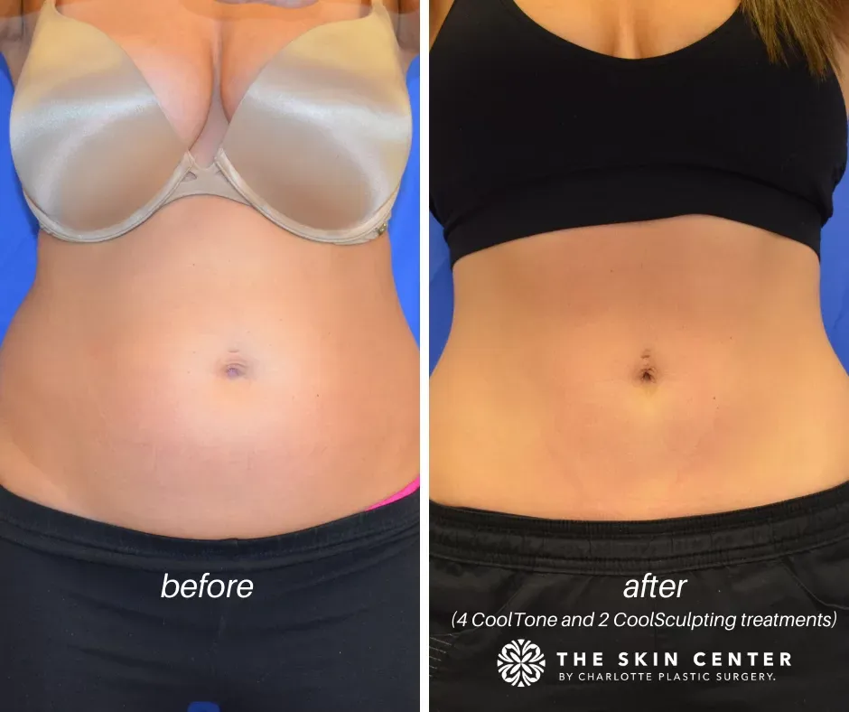 CoolTone Before & After