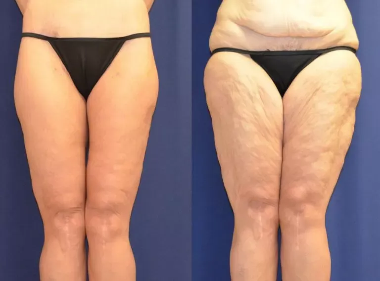 coolsculpting vs. liposuction
