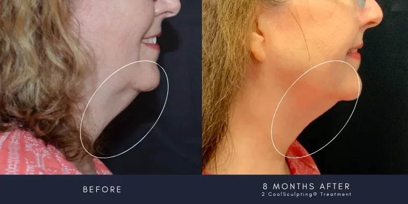 coolsculpting case 33 - side profile