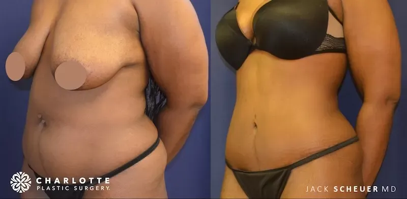 Before and After Mommy Makeover Results
