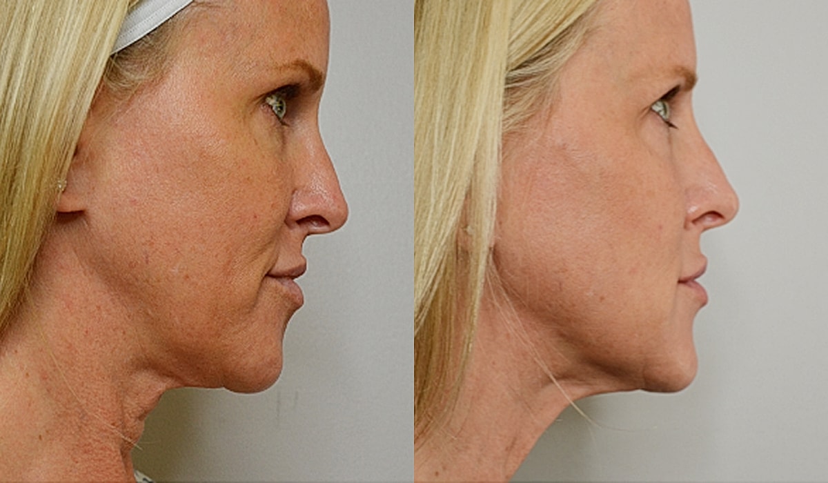 Profile comparisons of facial aesthetics and features.