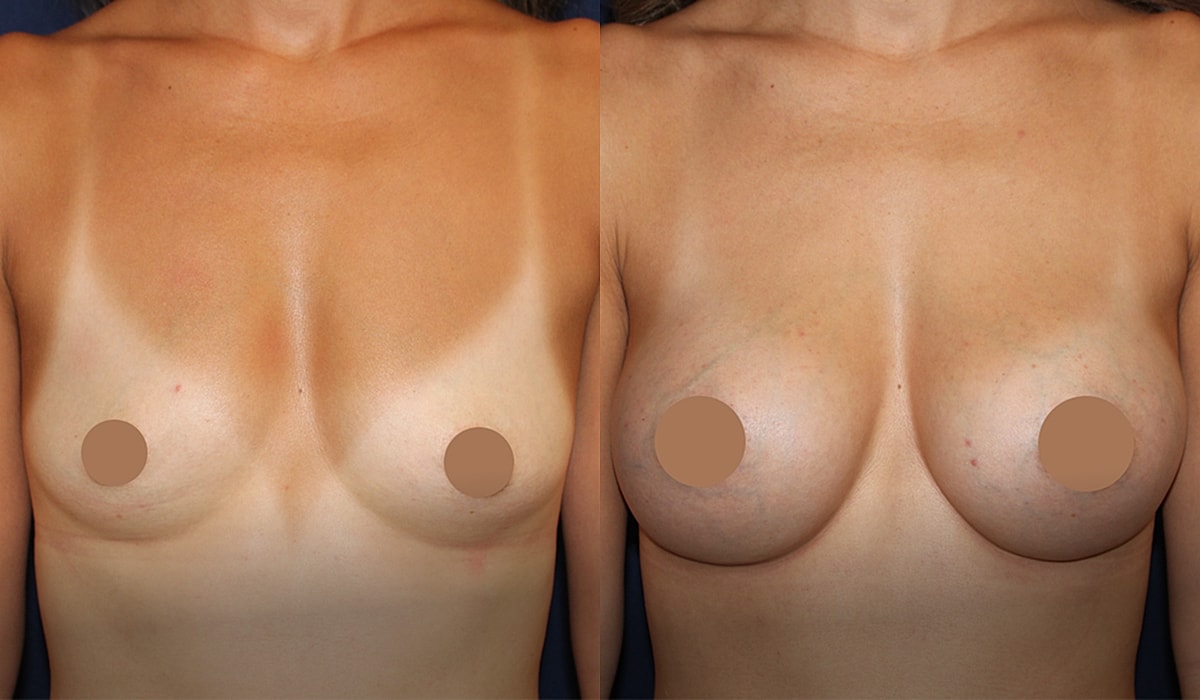 Before and after breast augmentation images.