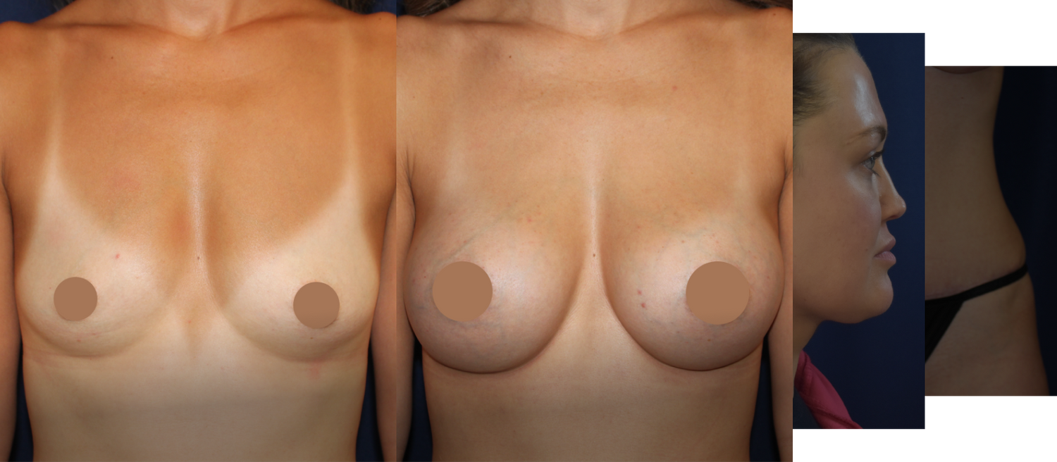 Charlotte Plastic Surgery patient before and after