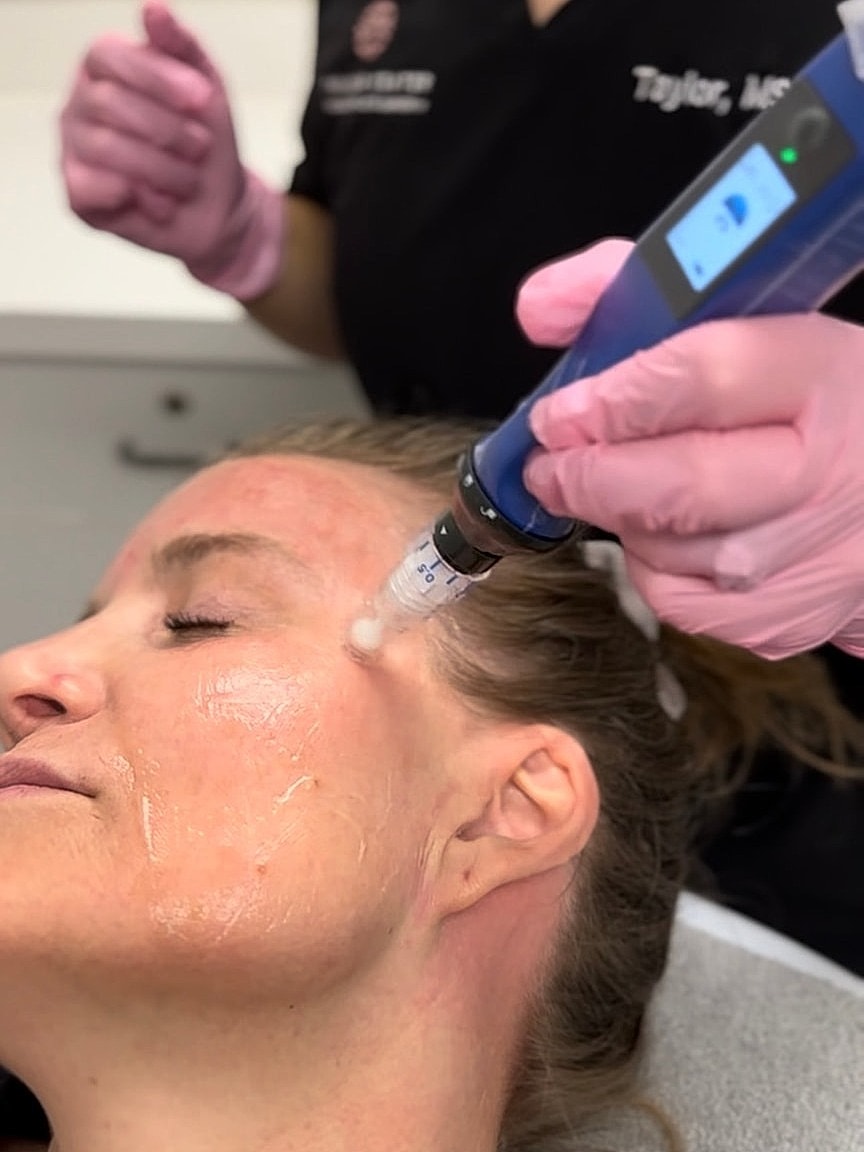 Microneedling Treatment