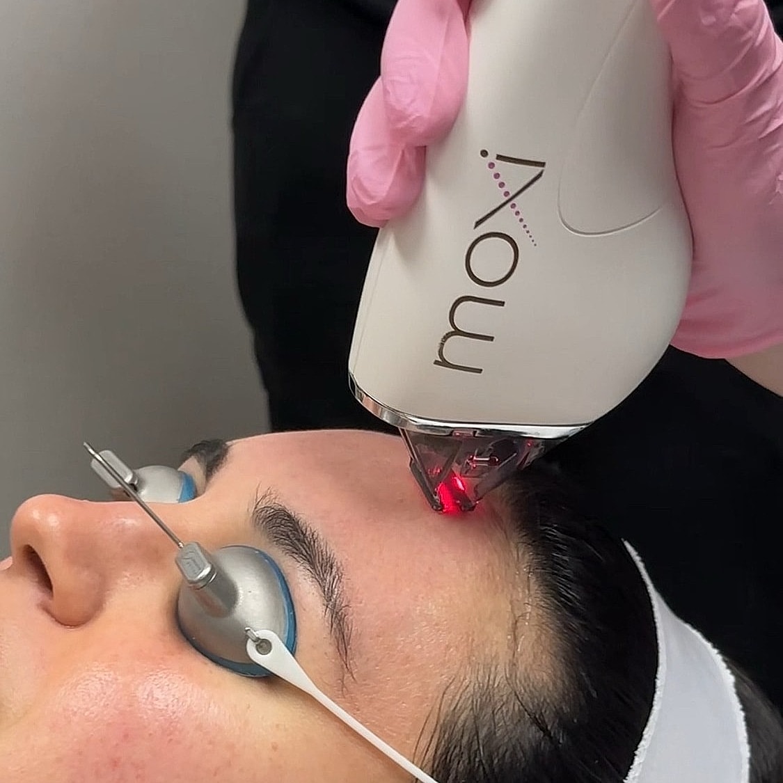 Laser treatment on a woman’s forehead.