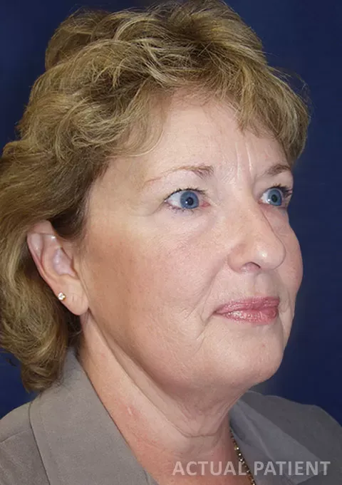 ballantyne plastic surgery patient before