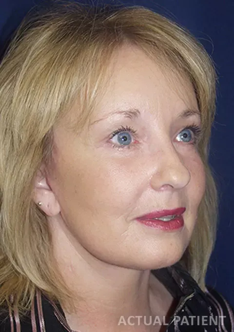 ballantyne plastic surgery patient after