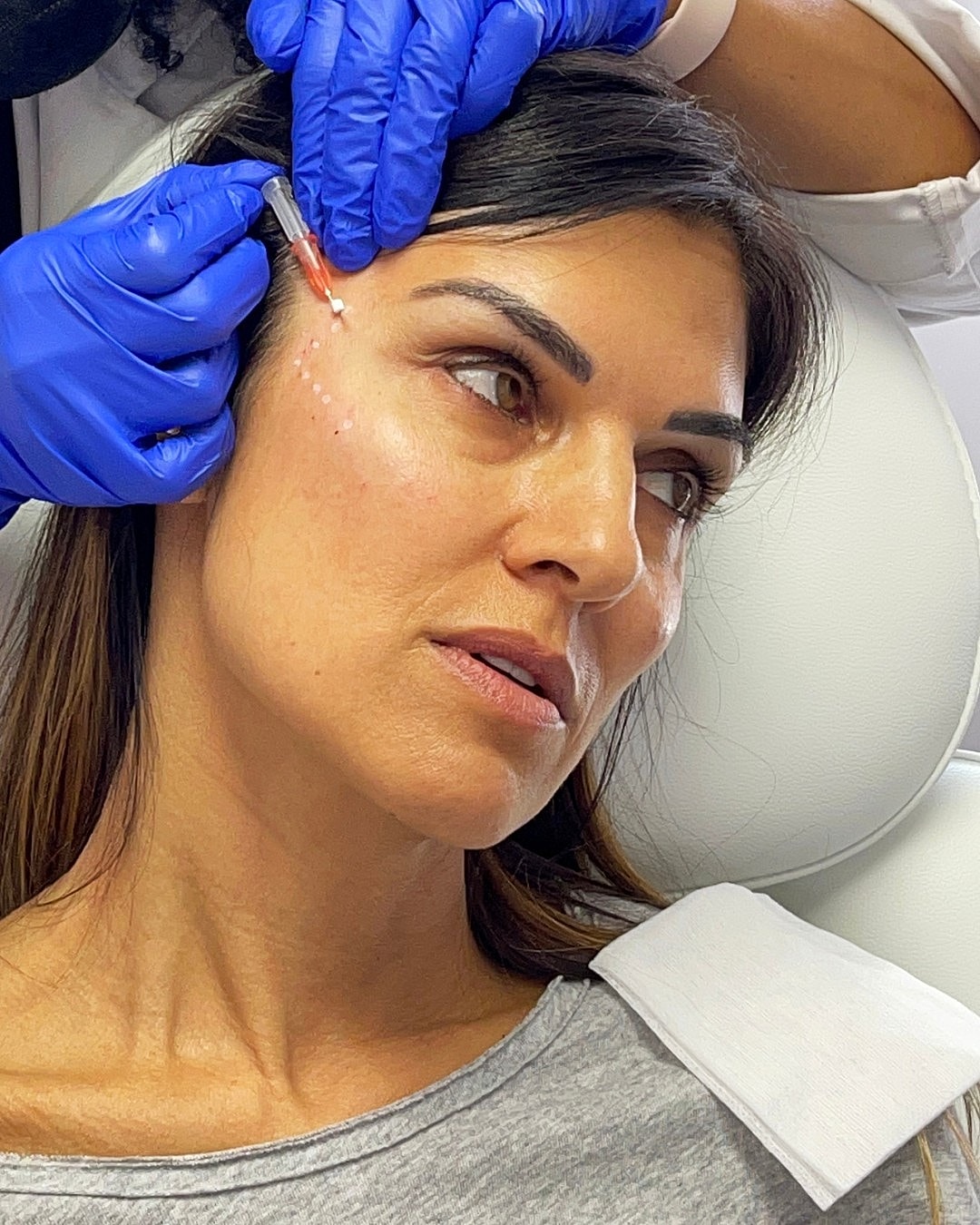 Woman receiving cosmetic treatment on her forehead.