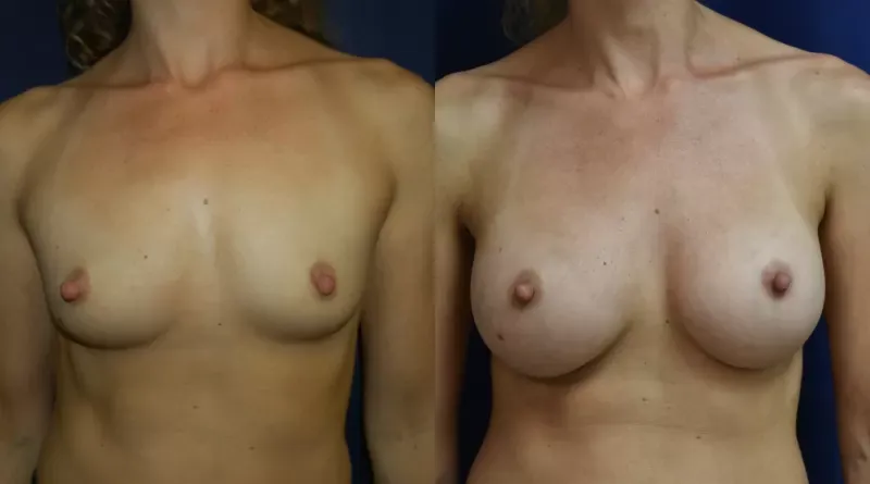 Breast Augmentation Before & After
