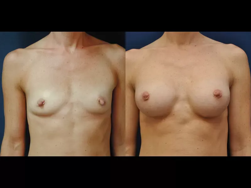 Breast Augmentation Before & After