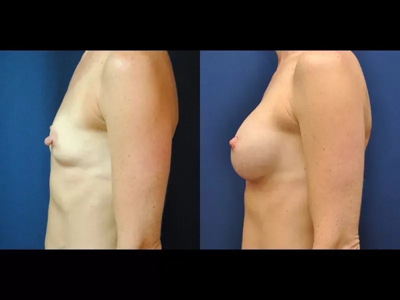Breast Augmentation Before & After