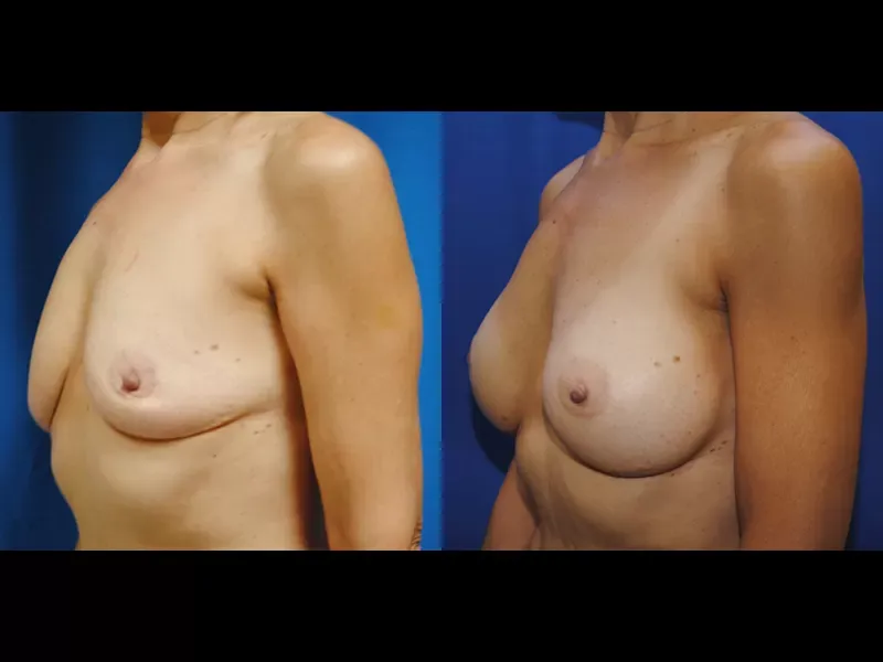 Breast Augmentation Before & After