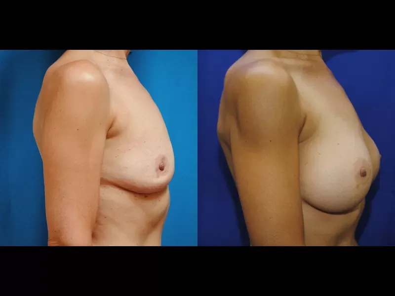 Breast Augmentation Before & After