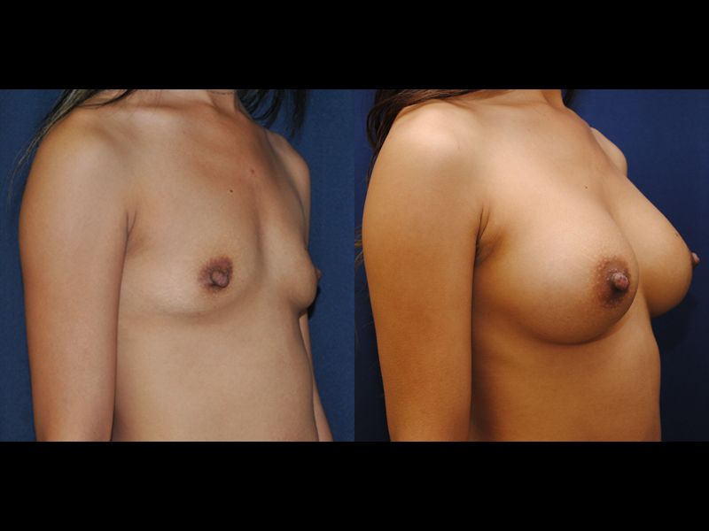 Breast Augmentation Before & After