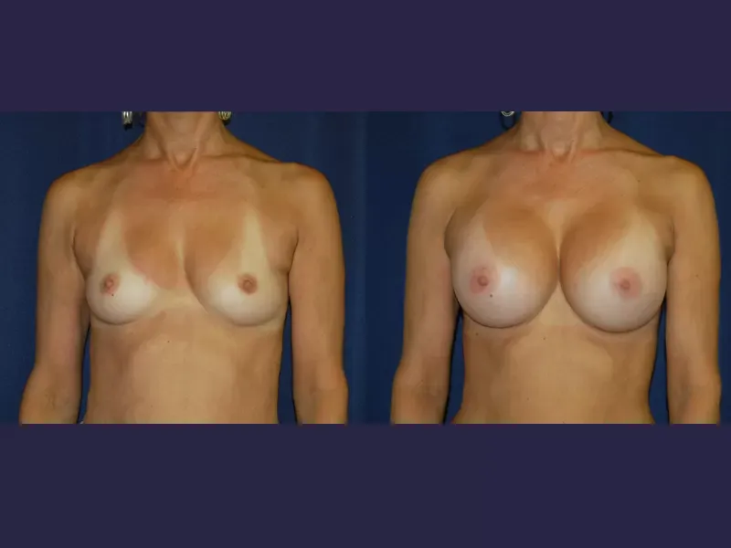 Breast Augmentation Before & After