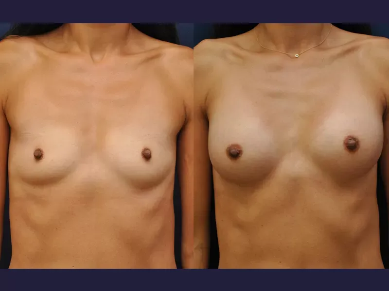 Breast Augmentation Before & After