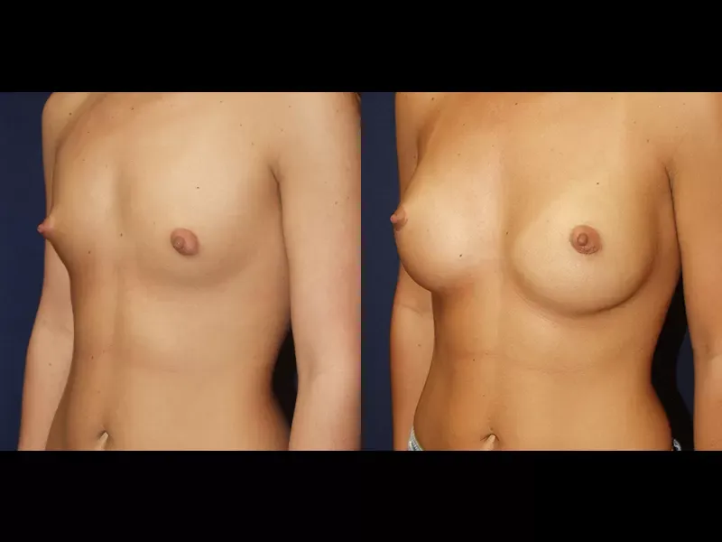 Breast Augmentation Before & After