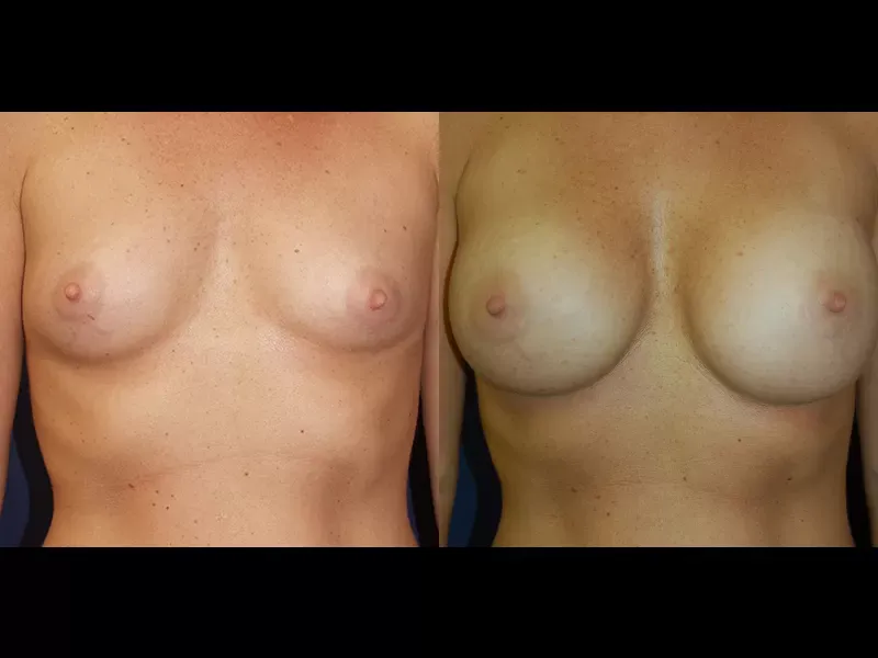 Breast Augmentation Before & After