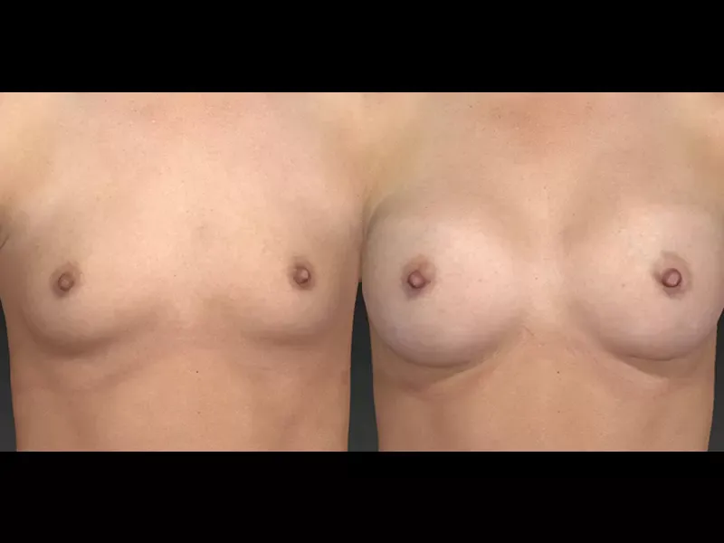 Breast Augmentation Before & After