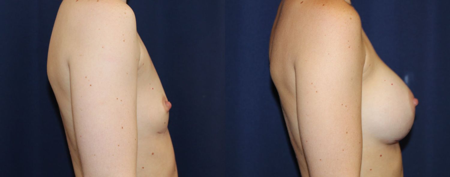 Breast Augmentation Before & After