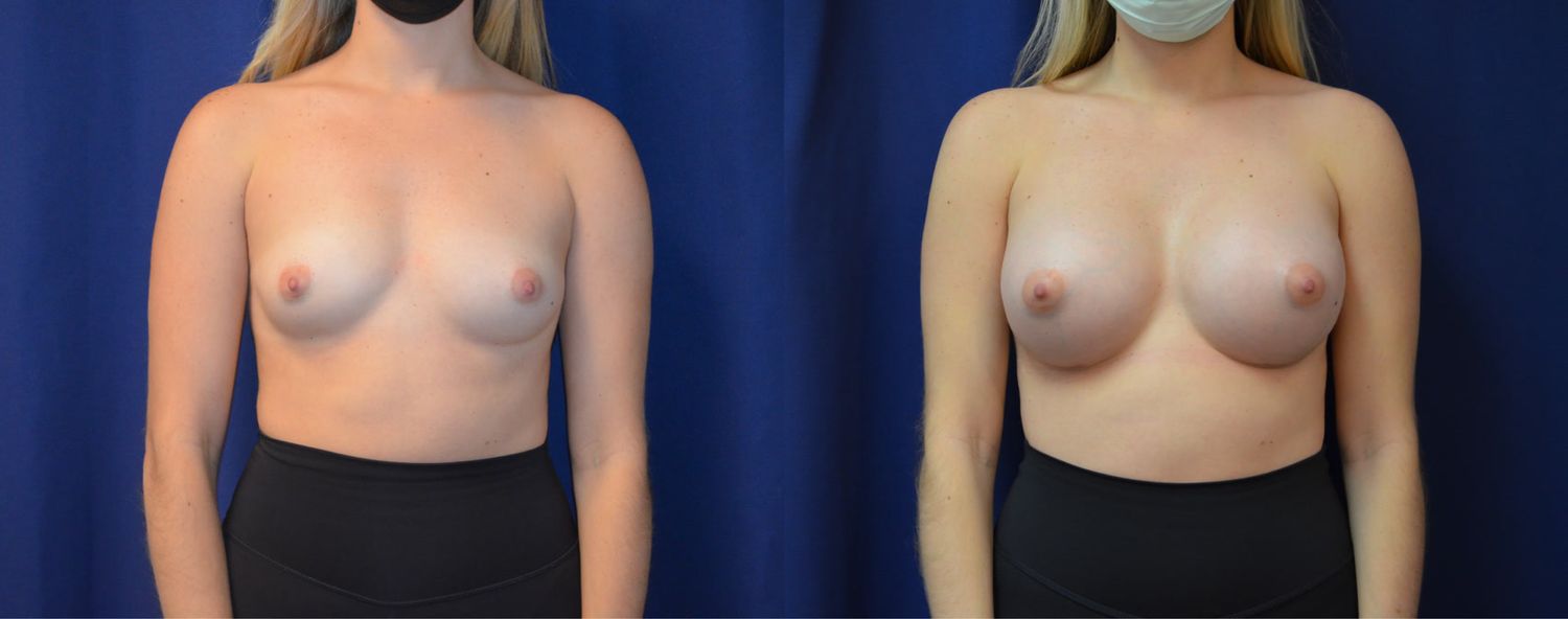 Breast Augmentation Before & After