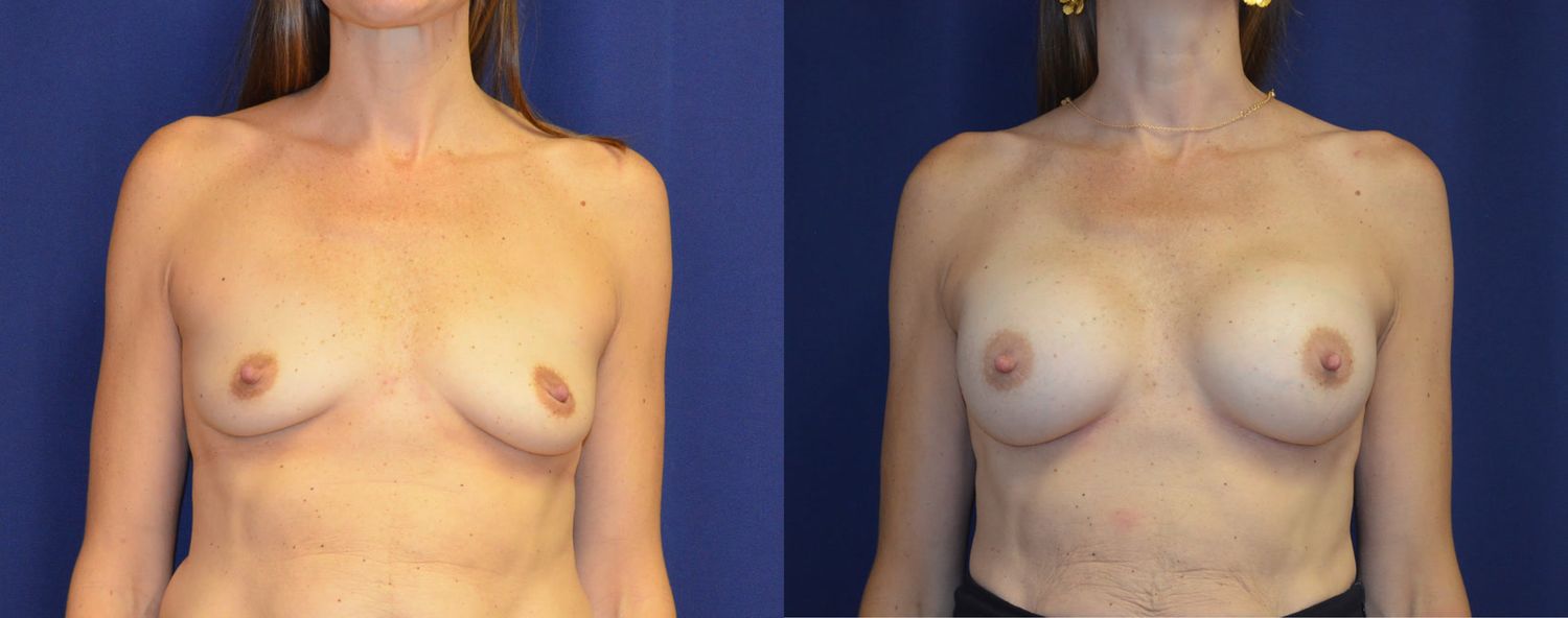 Breast Augmentation Before & After