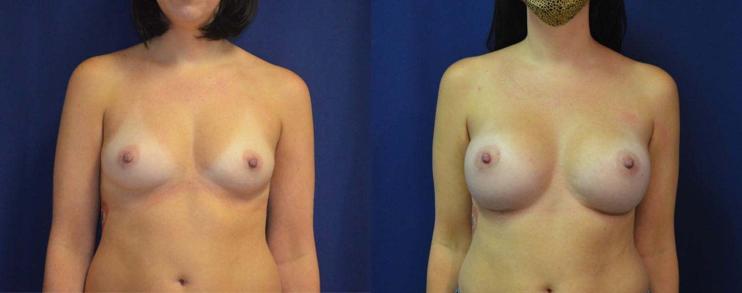 Breast Augmentation Before & After