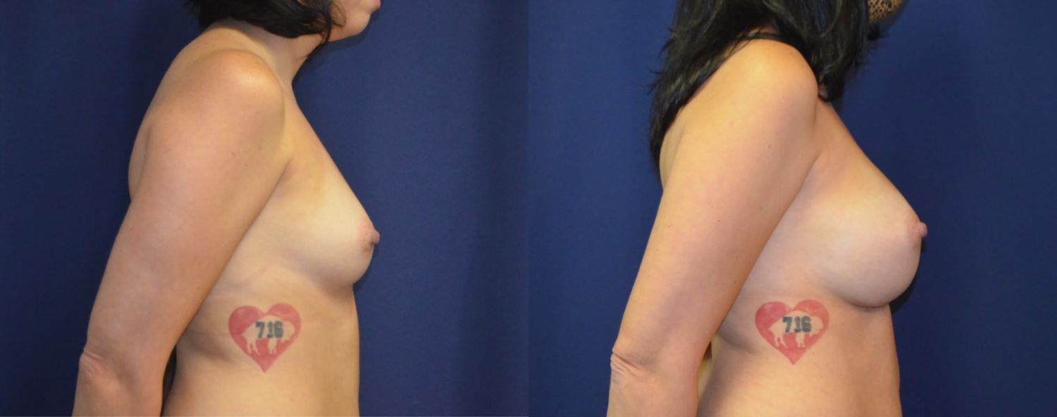 Breast Augmentation Before & After
