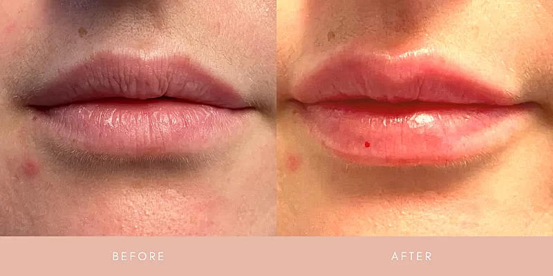 Dermal Fillers Before & After