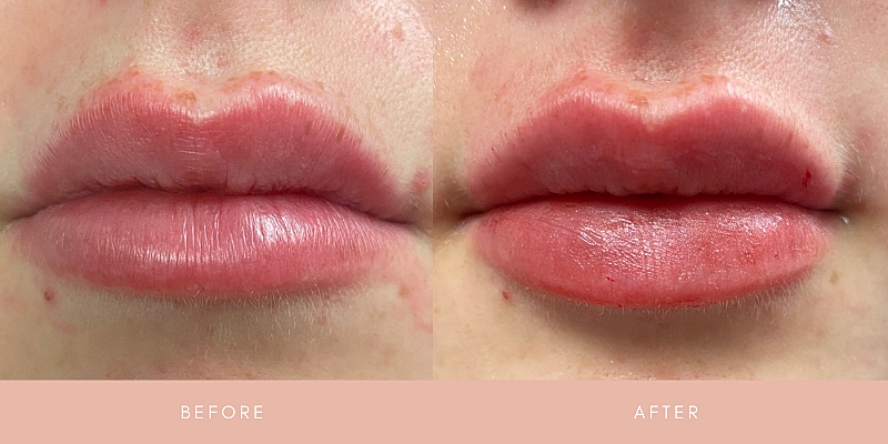 Dermal Fillers Before & After