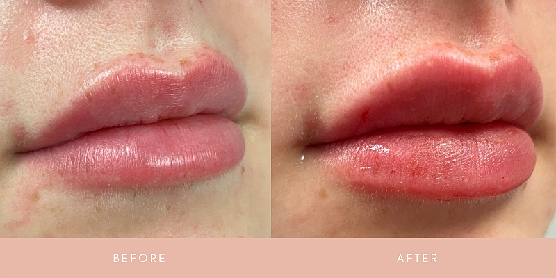 Dermal Fillers Before & After