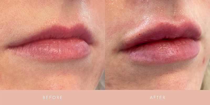 Dermal Fillers Before & After