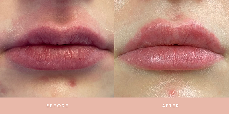 Dermal Fillers Before & After