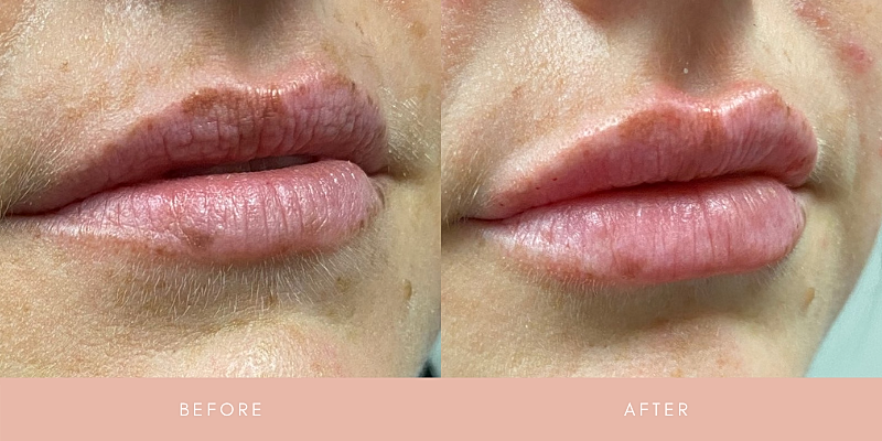 Dermal Fillers Before & After
