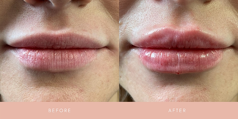 Dermal Fillers Before & After